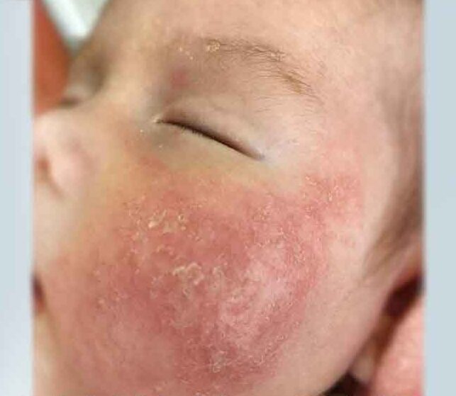 Thực hư việc nước A chữa chàm sữa cho em bé mùa hanh khô: Sự thật ba mẹ cần biết